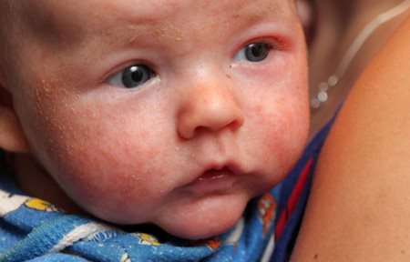 eczeem baby gezicht